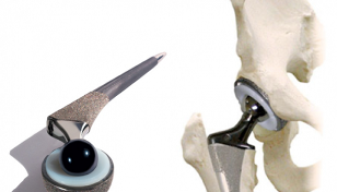 hip joint endoprosthesis due to osteoarthritis