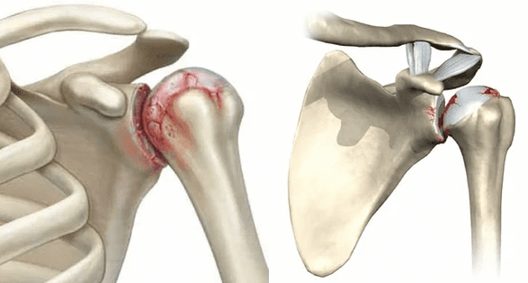 what osteoarthritis of the shoulder joint looks like