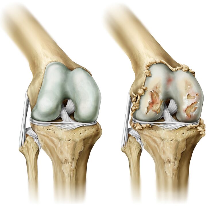what osteoarthritis looks like