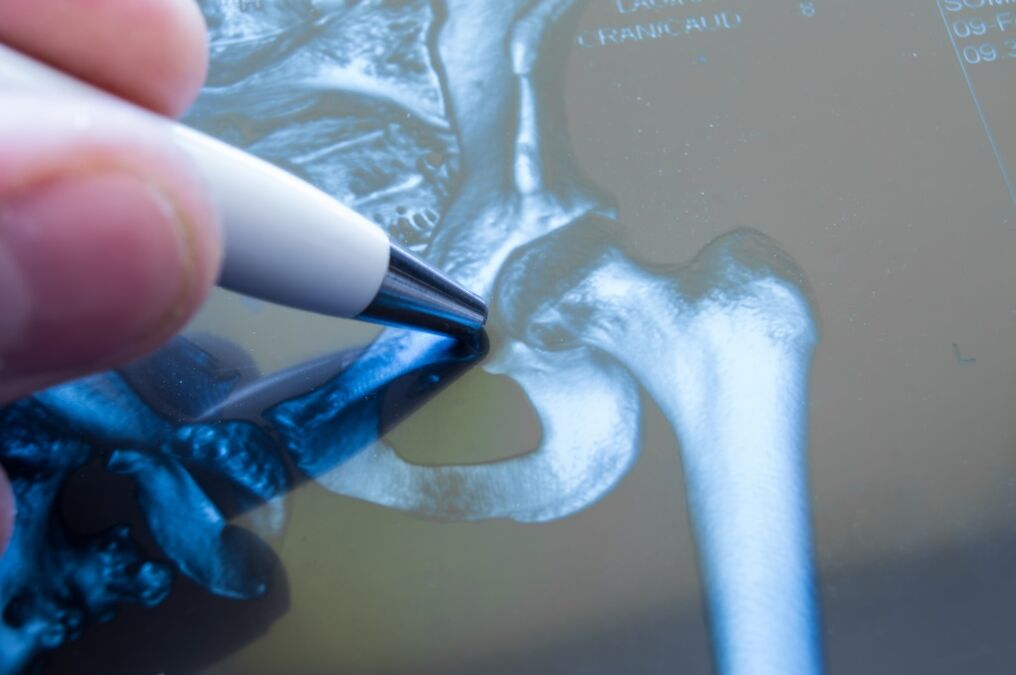 Osteoarthritis of the hip joint on radiograph
