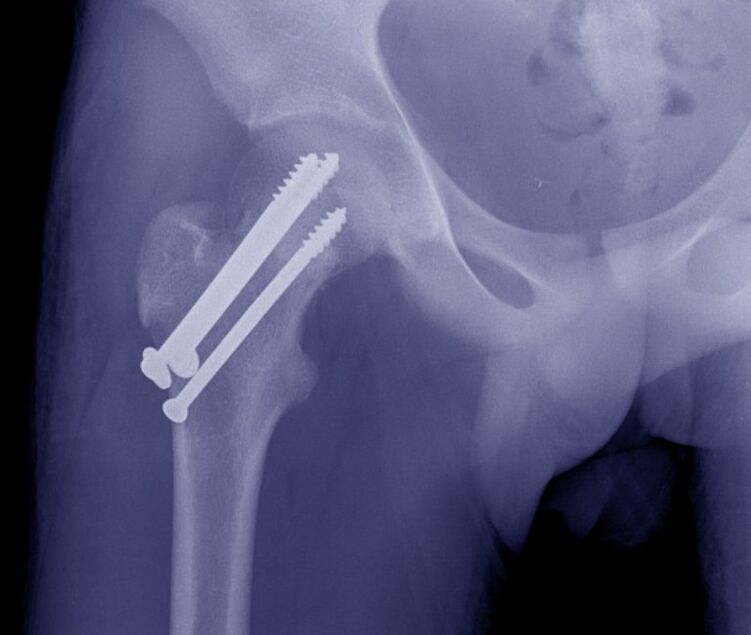 X-ray of the hip joint, osteosynthesis of the fracture by internal fixation devices