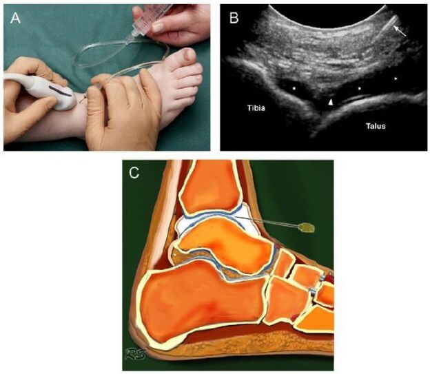 ankle ultrasound with osteoarthritis