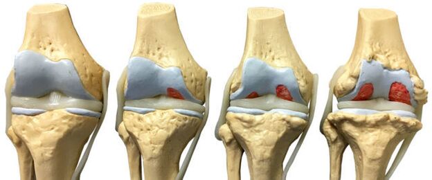 joint damage at different stages of ankle osteoarthritis development