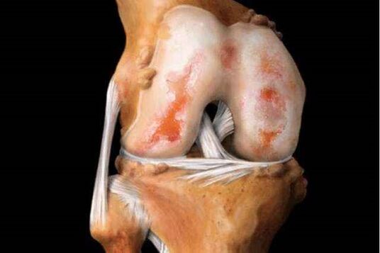 damage to the knee joint by arthrosis