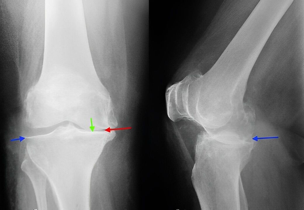 x-ray image of arthrosis of the knee joint