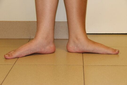 Sometimes the cause of arthrosis doors are flat feet