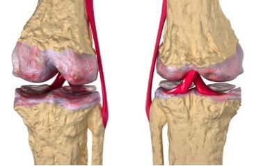 Varicose veins are the cause of the development of gonarthrosis